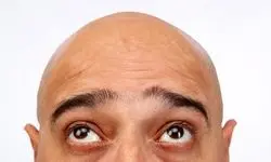 خبر خوب دانشمندان ژاپنی برای کچل‌ها