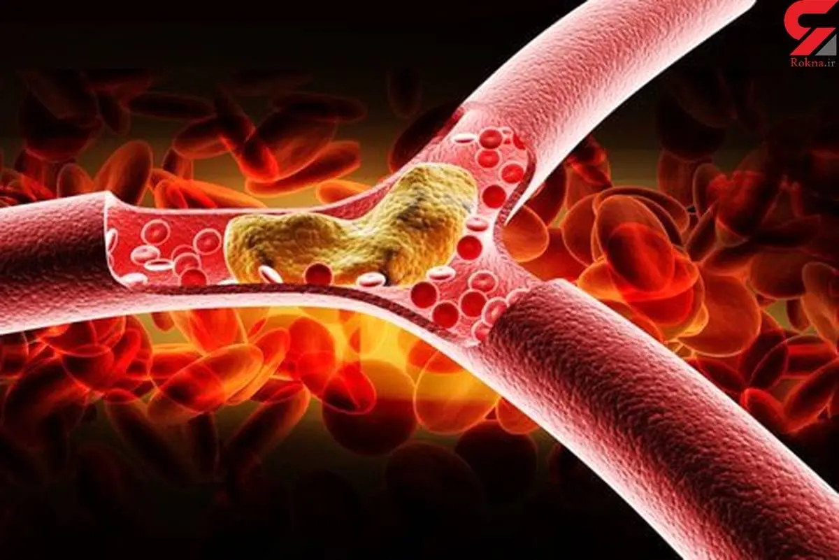 درمان طبیعی و سه سوته چربی و کلسترول خون