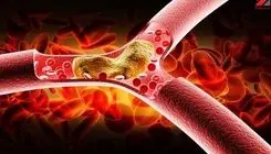 درمان طبیعی و سه سوته چربی و کلسترول خون