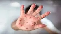 شیوع آبله‌مرغان در فصل بهار 