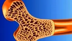 پوکی استخوان در نیمی از زنان بالای ۵۰ سال