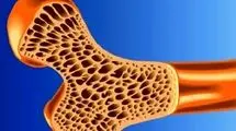 پوکی استخوان در نیمی از زنان بالای ۵۰ سال