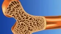 پوکی استخوان در نیمی از زنان بالای ۵۰ سال