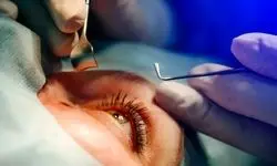 شیوع قوز قرنیه در ایران بالاتر از جهان 