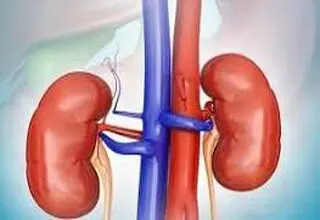 مصرف مشروبات الکلی تاثیری در روند بهبود سنگ کلیه دارد؟