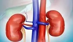مصرف مشروبات الکلی تاثیری در روند بهبود سنگ کلیه دارد؟
