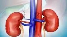 مصرف مشروبات الکلی تاثیری در روند بهبود سنگ کلیه دارد؟