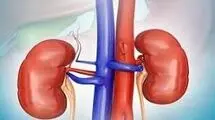 مصرف مشروبات الکلی تاثیری در روند بهبود سنگ کلیه دارد؟