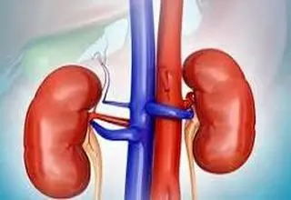 مصرف مشروبات الکلی تاثیری در روند بهبود سنگ کلیه دارد؟