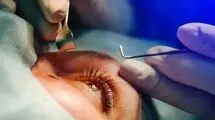 ماجرای حذف کامل عینک با جراحی 