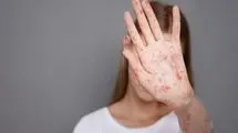 سرخک، زخم کهنه‌‌ای که سر باز  کرده است