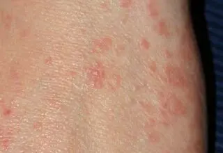 وزارت بهداشت شیوع بیماری گال را تایید نکرد