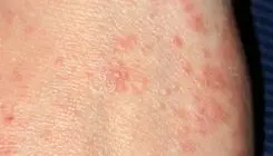 وزارت بهداشت شیوع بیماری گال را تایید نکرد