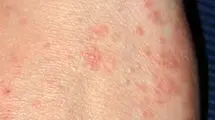 وزارت بهداشت شیوع بیماری گال را تایید نکرد