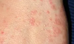 وزارت بهداشت شیوع بیماری گال را تایید نکرد