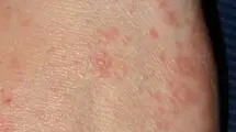 وزارت بهداشت شیوع بیماری گال را تایید نکرد