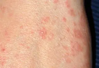 وزارت بهداشت شیوع بیماری گال را تایید نکرد