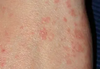 وزارت بهداشت شیوع بیماری گال را تایید نکرد