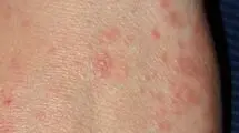 وزارت بهداشت شیوع بیماری گال را تایید نکرد