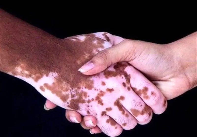 عامل تشدید بیماری پیسی