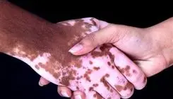عامل تشدید بیماری پیسی