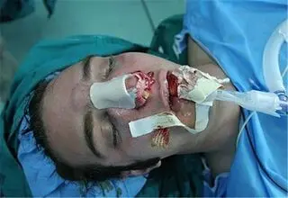 جزئیات باورنکردنی جراحی بینی بدون بیهوشی توسط دستیار دیپلمه پزشک 