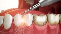 راهکار‌های برای پیشگیری از تشکیل جرم دندان
