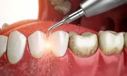 سلامت تضمینی دندان‌ها با این راهکار