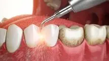 سلامت تضمینی دندان‌ها با این راهکار