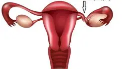 علت بزرگ شدن رحم چیست؟