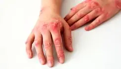 بیماری‌ای که اغلب دامن‌گیر زنان است/ نگاهی به بیماری لاعلاج «سلنا گومز»