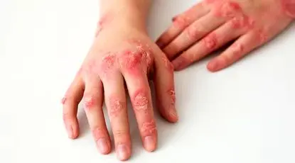 بیماری‌ای که اغلب دامن‌گیر زنان است/ نگاهی به بیماری لاعلاج «سلنا گومز»