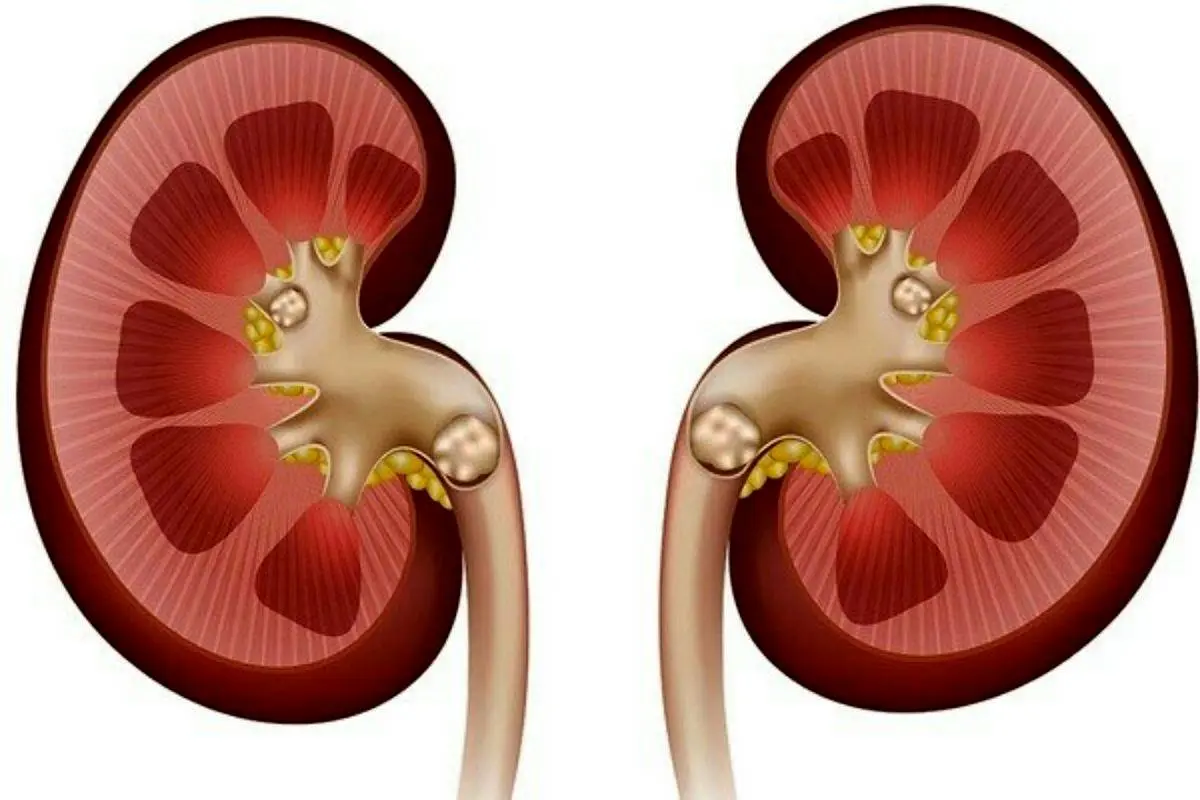 چند درصد ایرانیها سنگ کلیه دارند؟