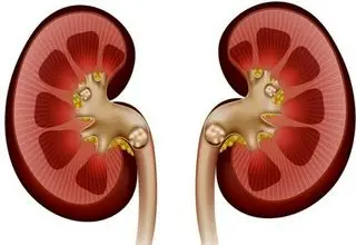 چند درصد ایرانی‌‎ها سنگ کلیه دارند؟