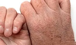 دلیل ترک خوردن پوست +درمان