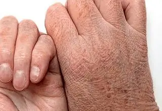 دلیل ترک خوردن پوست +درمان