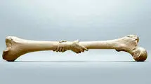  ۴۲ درصد زنان بالای ۶۰ سال و ۲۴ درصد آقایان بالای ۵۰ سال به این بیماری مبتلا هستند