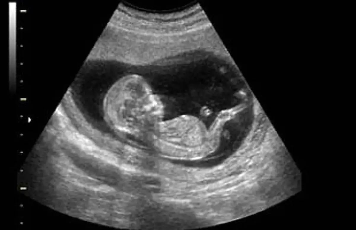 از هر شش زوج ایرانی، یک زوج نابارور است