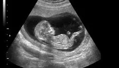 از هر شش زوج ایرانی، یک زوج نابارور است