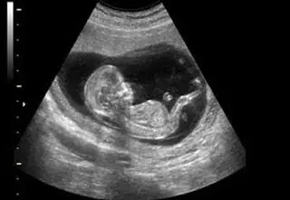 از هر شش زوج ایرانی، یک زوج نابارور است