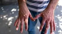 هشدار دانشمندان درباره شیوع انسانی آبله میمون