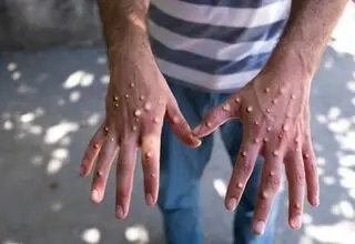 هشدار دانشمندان درباره شیوع انسانی آبله میمون