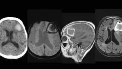 چرا آمیلوئید عروقی مغز خطرناک است؟+ویدیو 