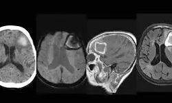 چرا آمیلوئید عروقی مغز خطرناک است؟+ویدیو 