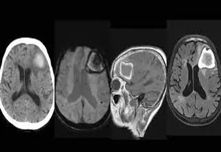 چرا آمیلوئید عروقی مغز خطرناک است؟+ویدیو 