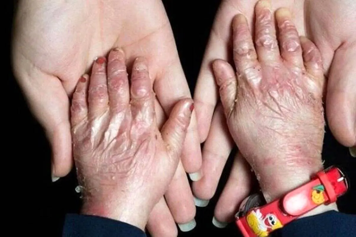 تحویل پانسمانهای تخصصی بیماران پروانهای