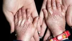 تحویل پانسمان‌های تخصصی بیماران پروانه‌ای