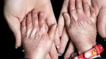 تحویل پانسمانهای تخصصی بیماران پروانهای