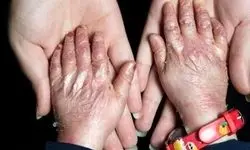 تحویل پانسمان‌های تخصصی بیماران پروانه‌ای