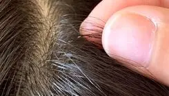 ترفندهایی برای خلاصی کودک از شپش